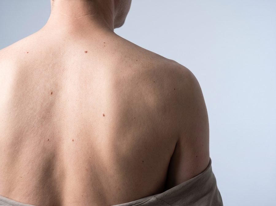 Melanoma ir odos vėžys