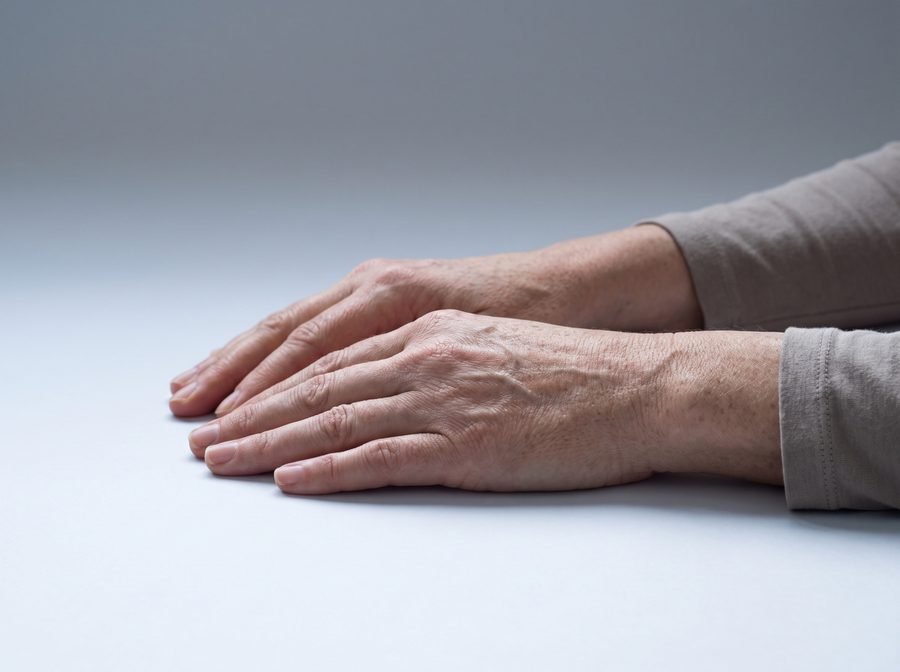 Pigmentinės dėmės